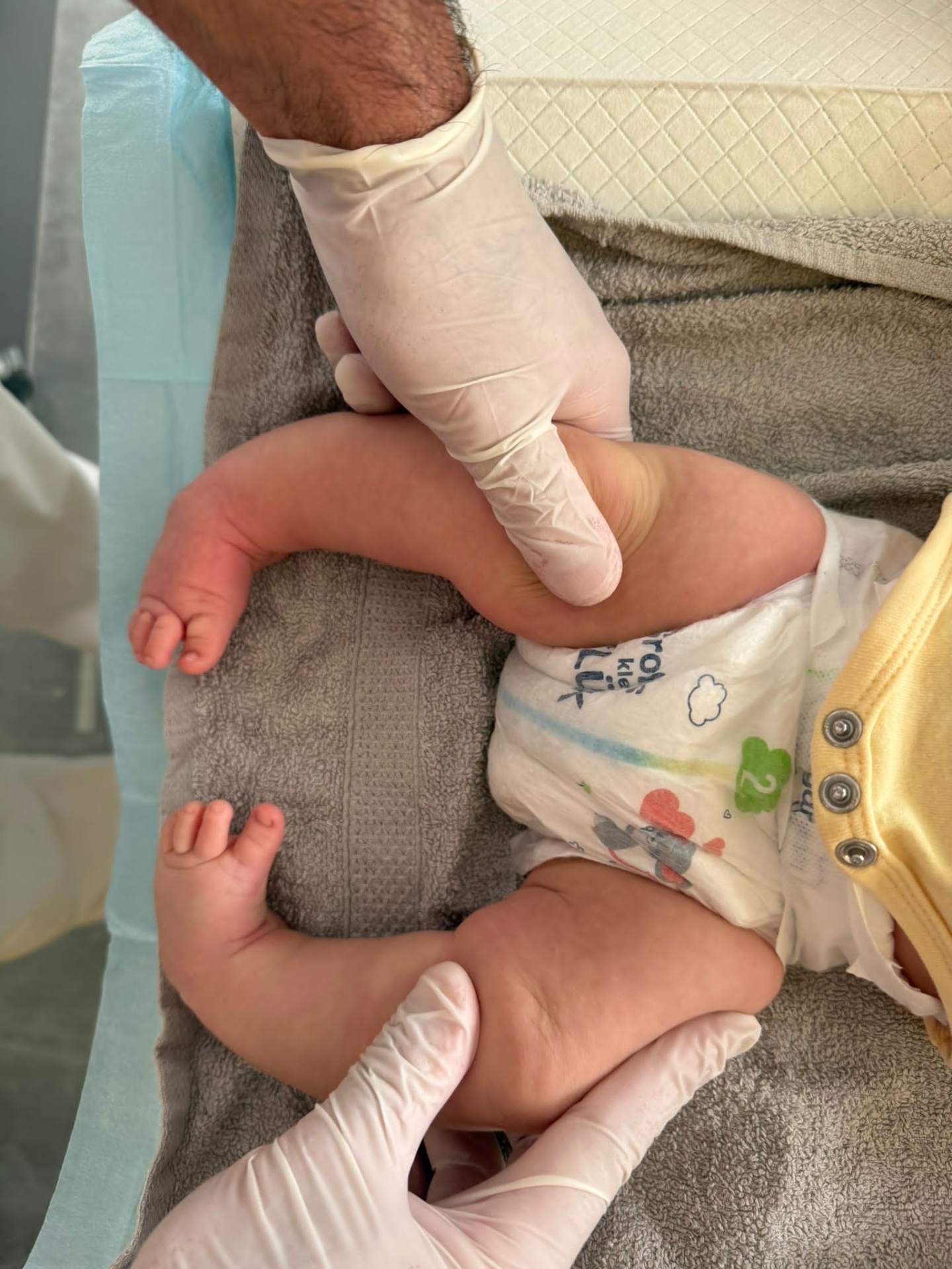 Bilateral clubfoot before treatment — initial presentation