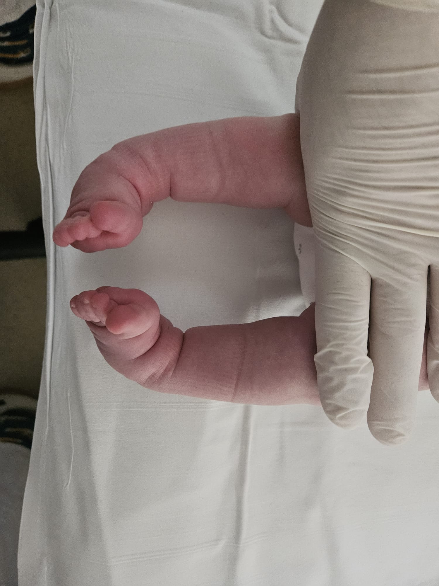 Newborn presentation — bilateral clubfoot before treatment