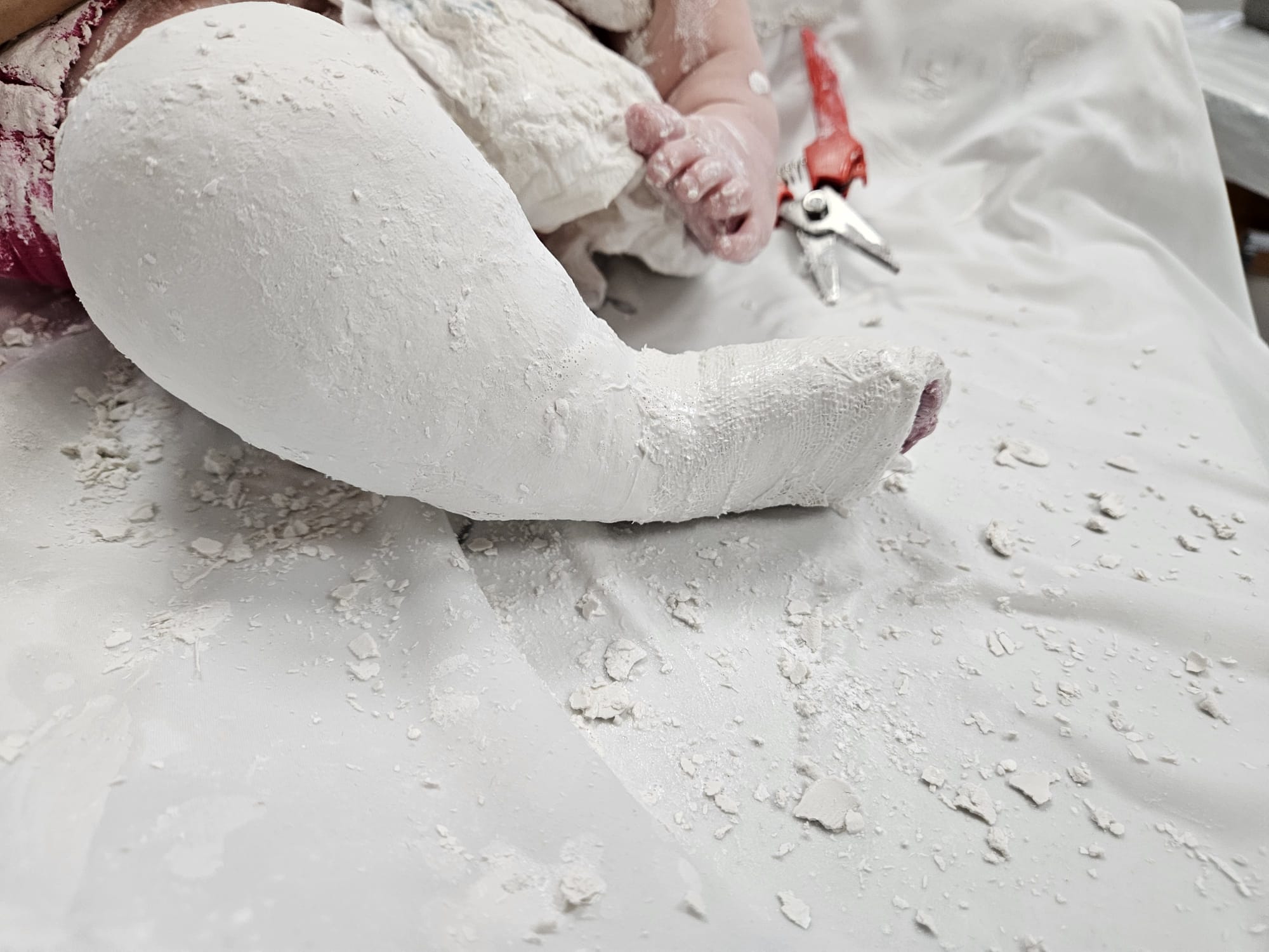 Ponseti casting — long-leg plaster cast applied