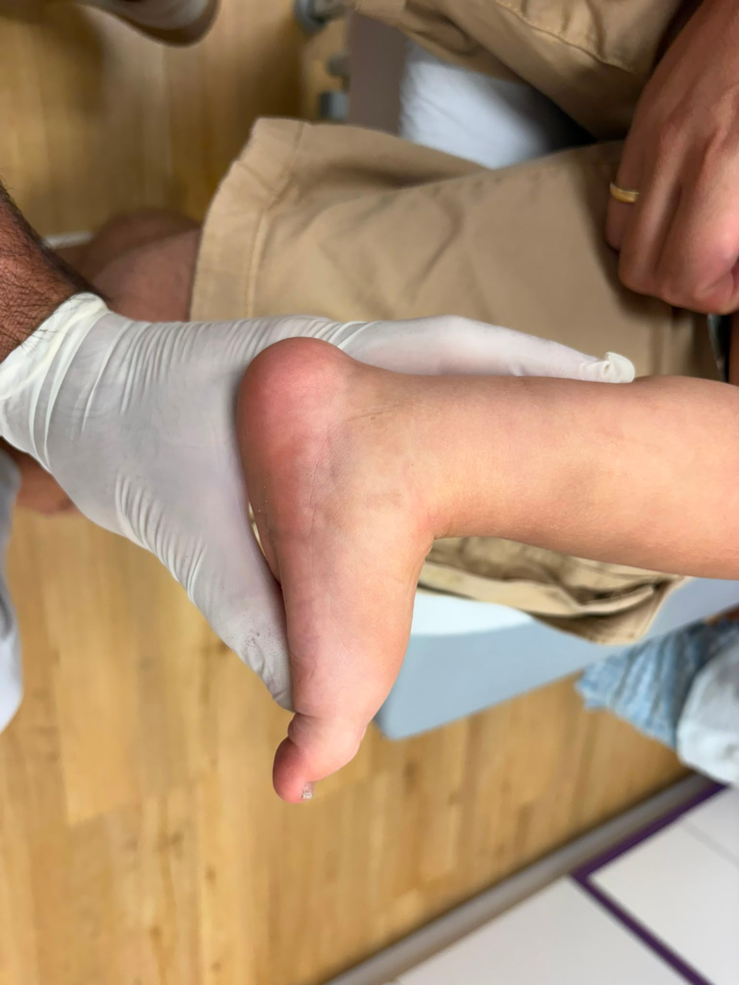 Long-term result in an older child — corrected foot, normal function