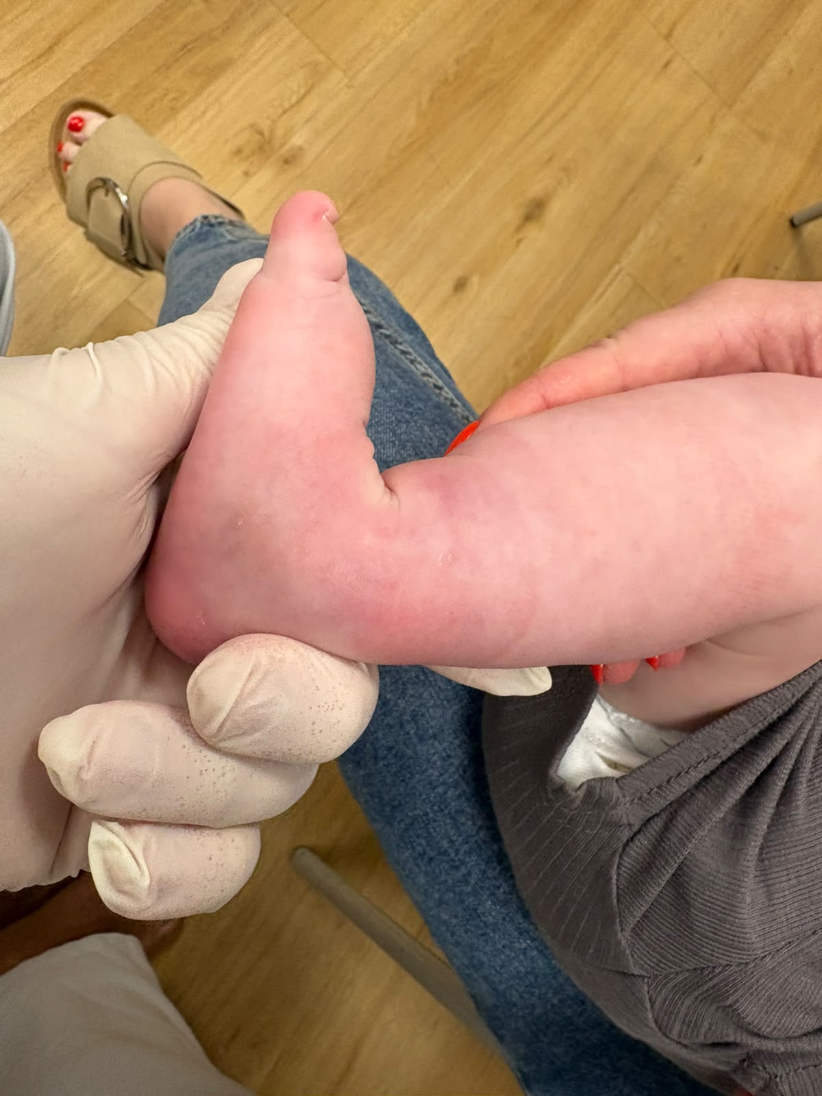 Corrected foot after the Ponseti series — full flexibility restored