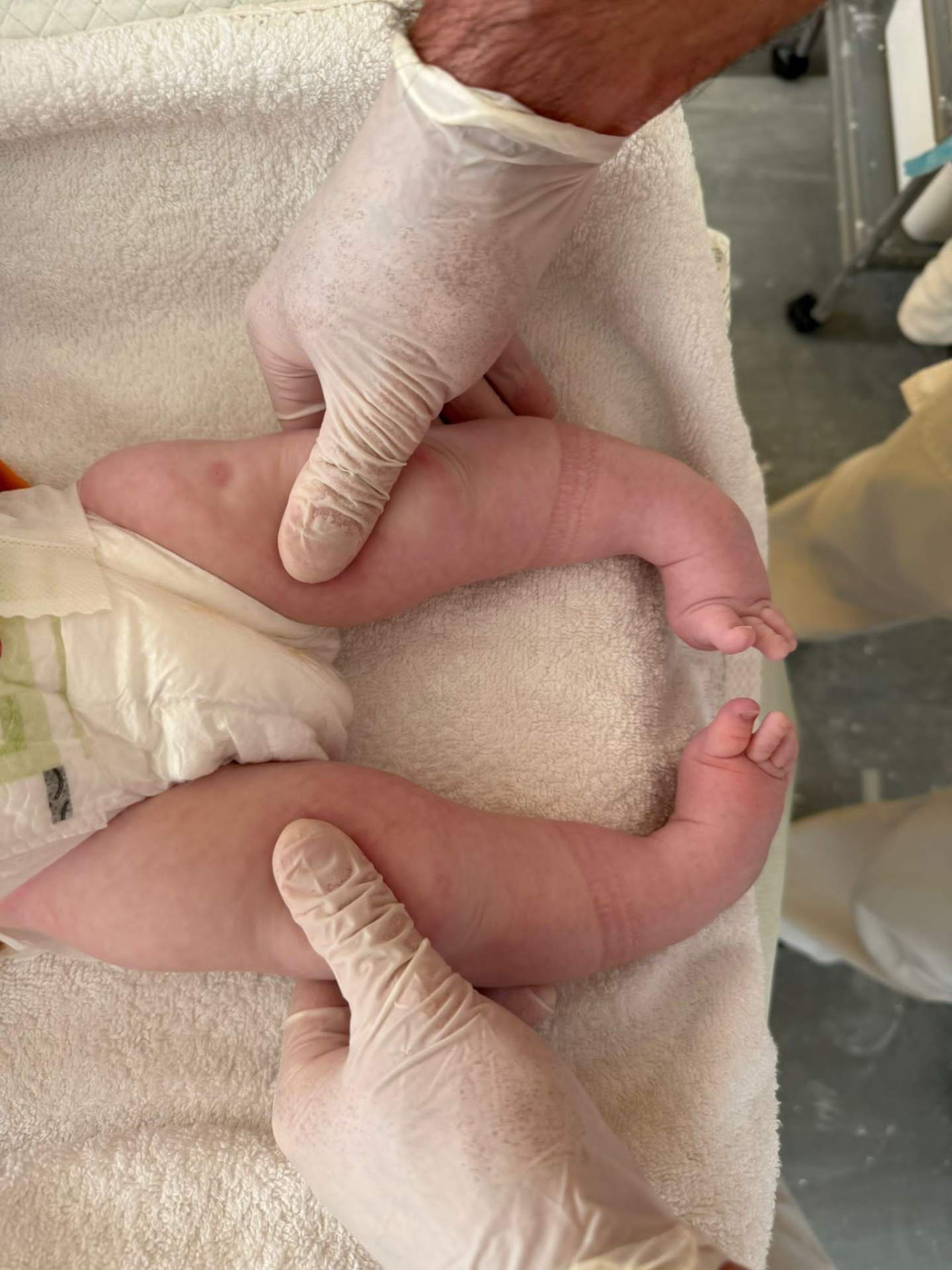 Examination of foot position prior to first cast