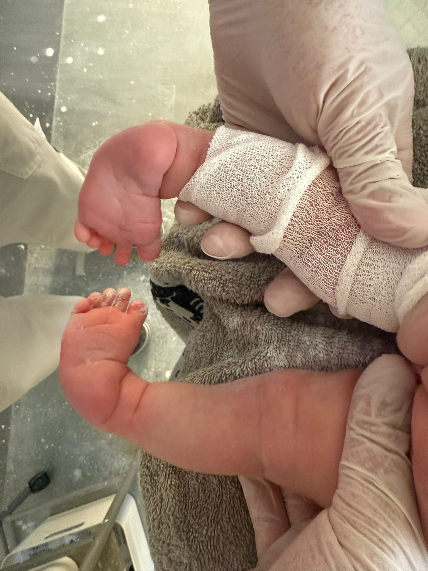 Close-up of clubfoot deformity prior to Ponseti treatment